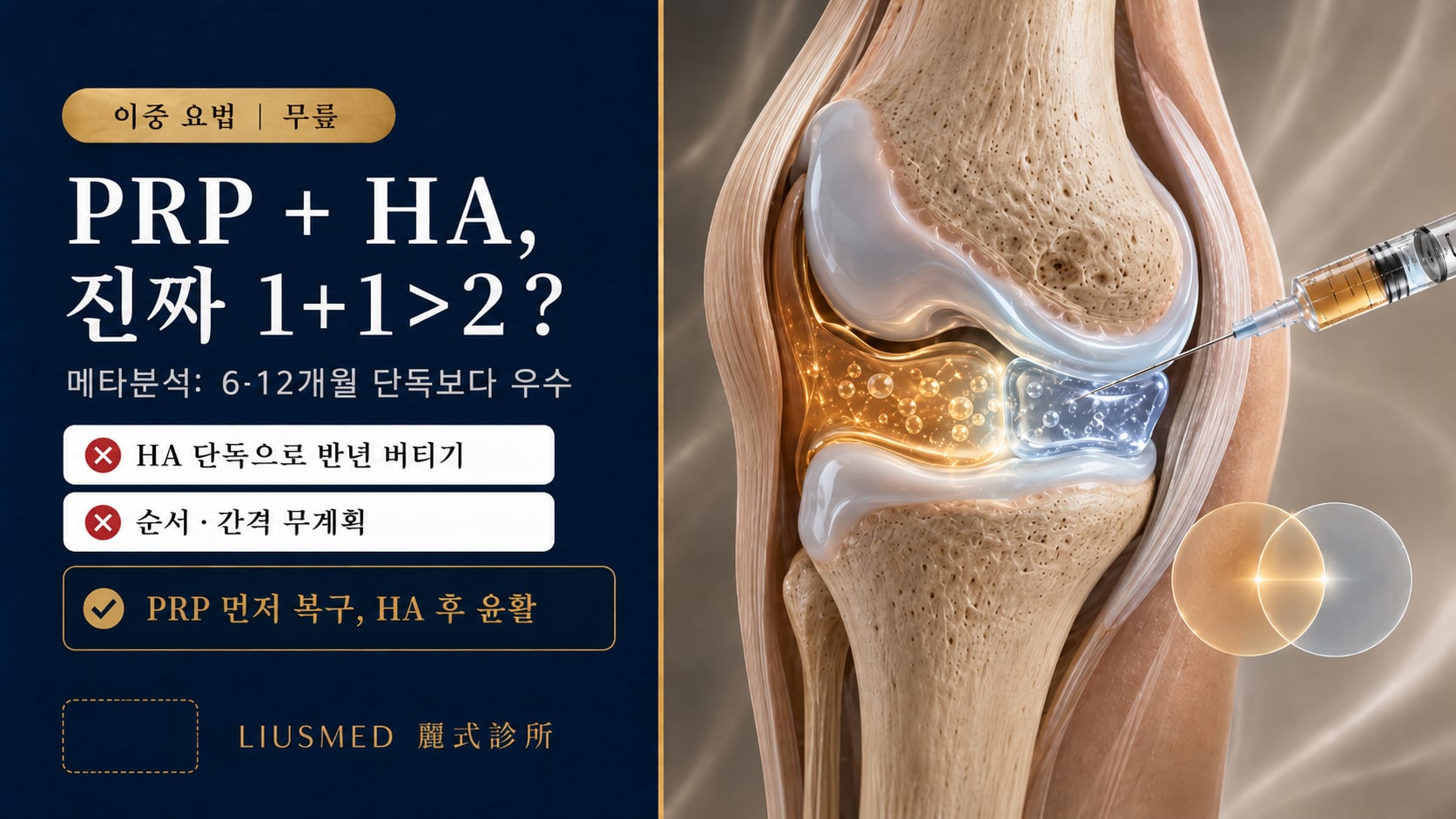 PRP + 히알루론산(HA) 무릎 관절 병용: 근거, 기전 및 최적 프로토콜 설계(2026 완벽 가이드)