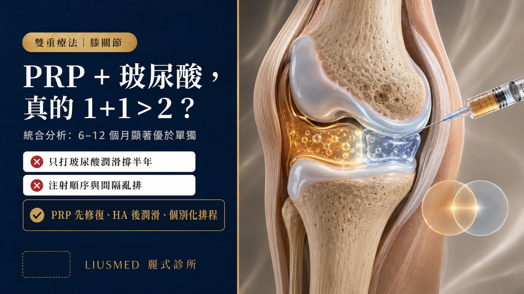 PRP + 玻尿酸（HA）膝關節併用：證據、機轉與最佳療程設計（2026 完整指南）