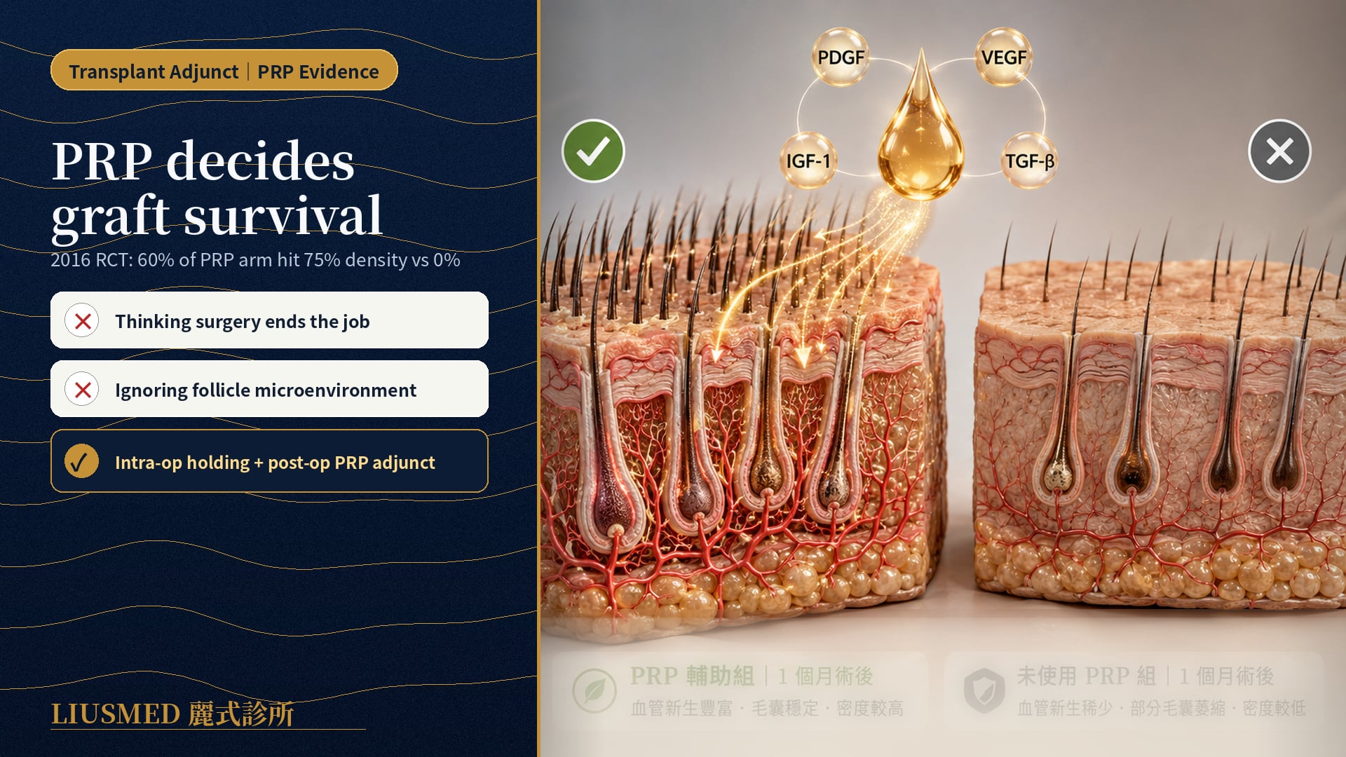 PRP Adjunct vs No PRP After Hair Transplant: Real Differences in Follicle Survival and Density (2026 Systematic Review)