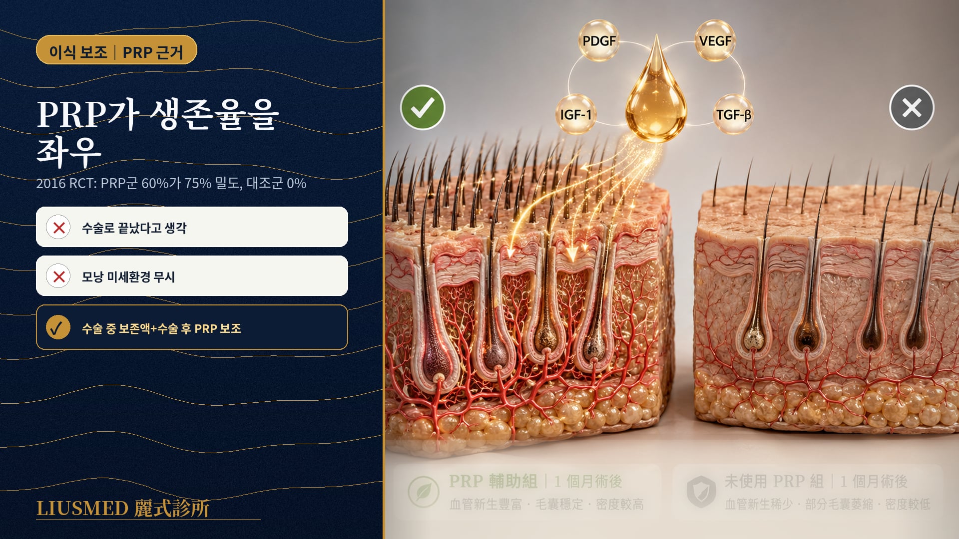 모발 이식 후 PRP 보조 vs 비보조: 모낭 생존과 밀도의 실제 차이(2026 체계적 검토)