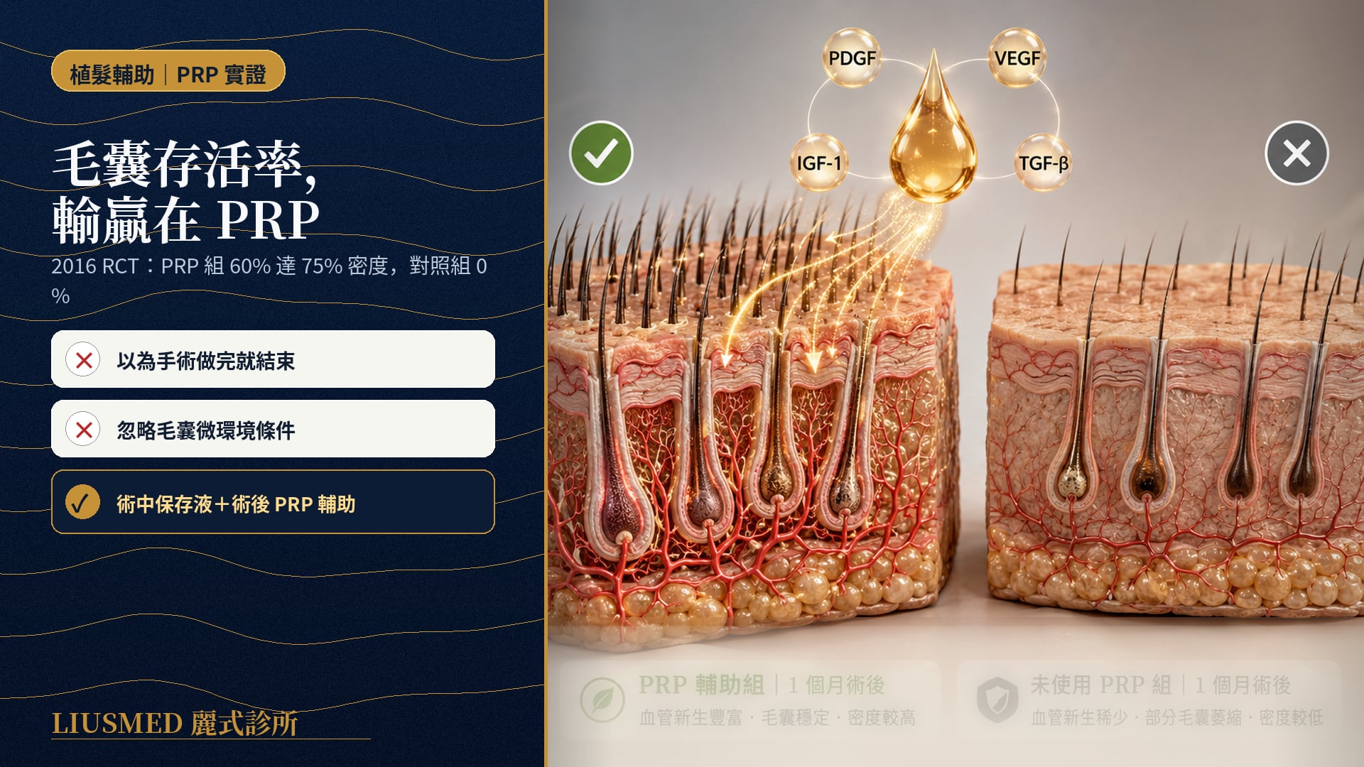 植髮後 PRP 輔助 vs 不輔助：對毛囊存活與密度的真實差異（2026 系統性回顧）
