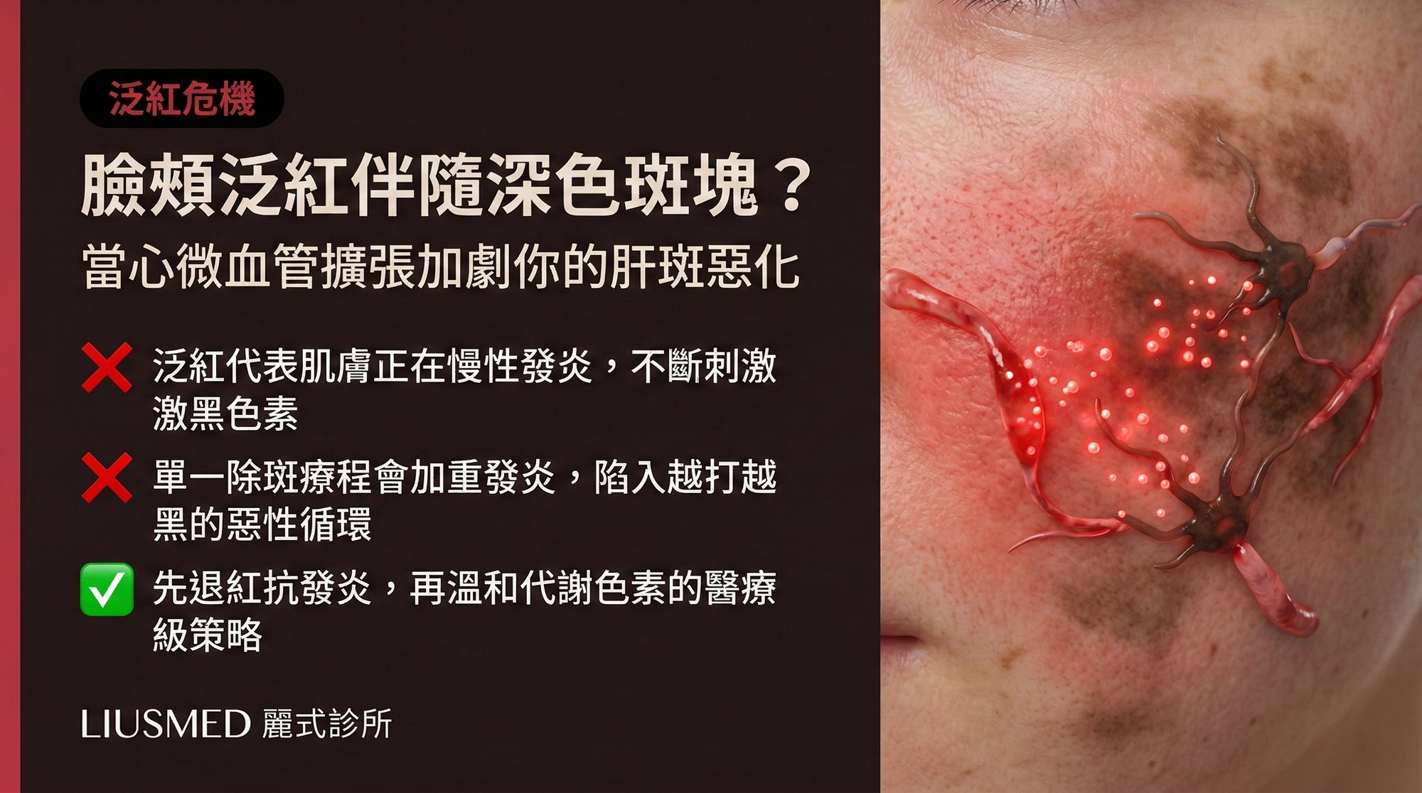 臉頰泛紅伴隨深色斑塊?當心微血管擴張加劇你的肝斑惡化