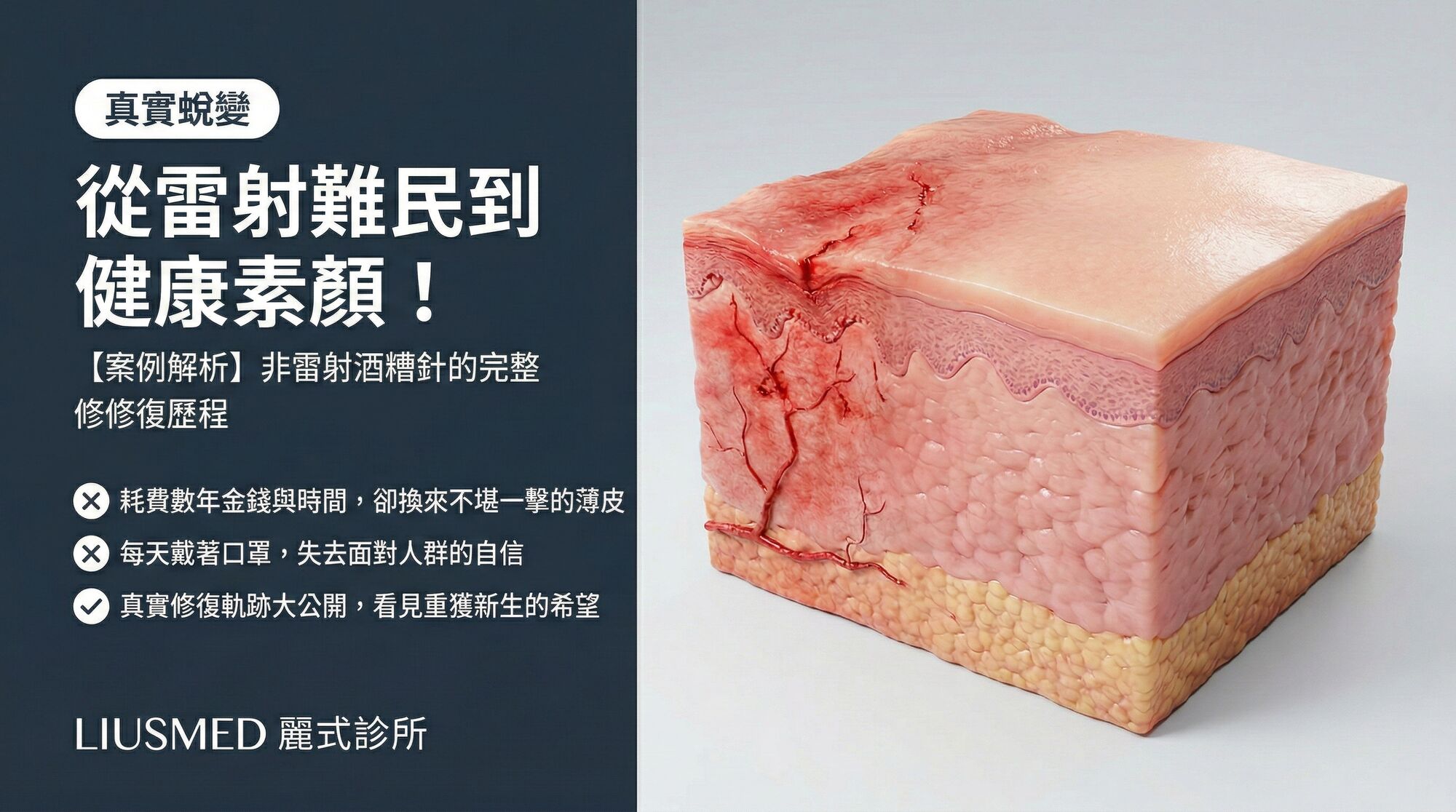 【案例解析】從雷射難民到找回健康素顏,非雷射酒糟針的完整修復歷程