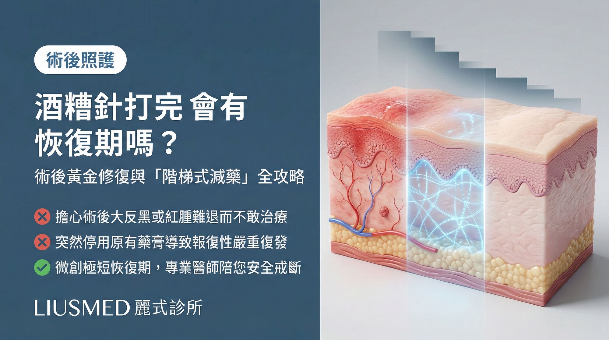 酒糟針打完會有恢復期嗎?術後修復與「階梯式減藥」全攻略