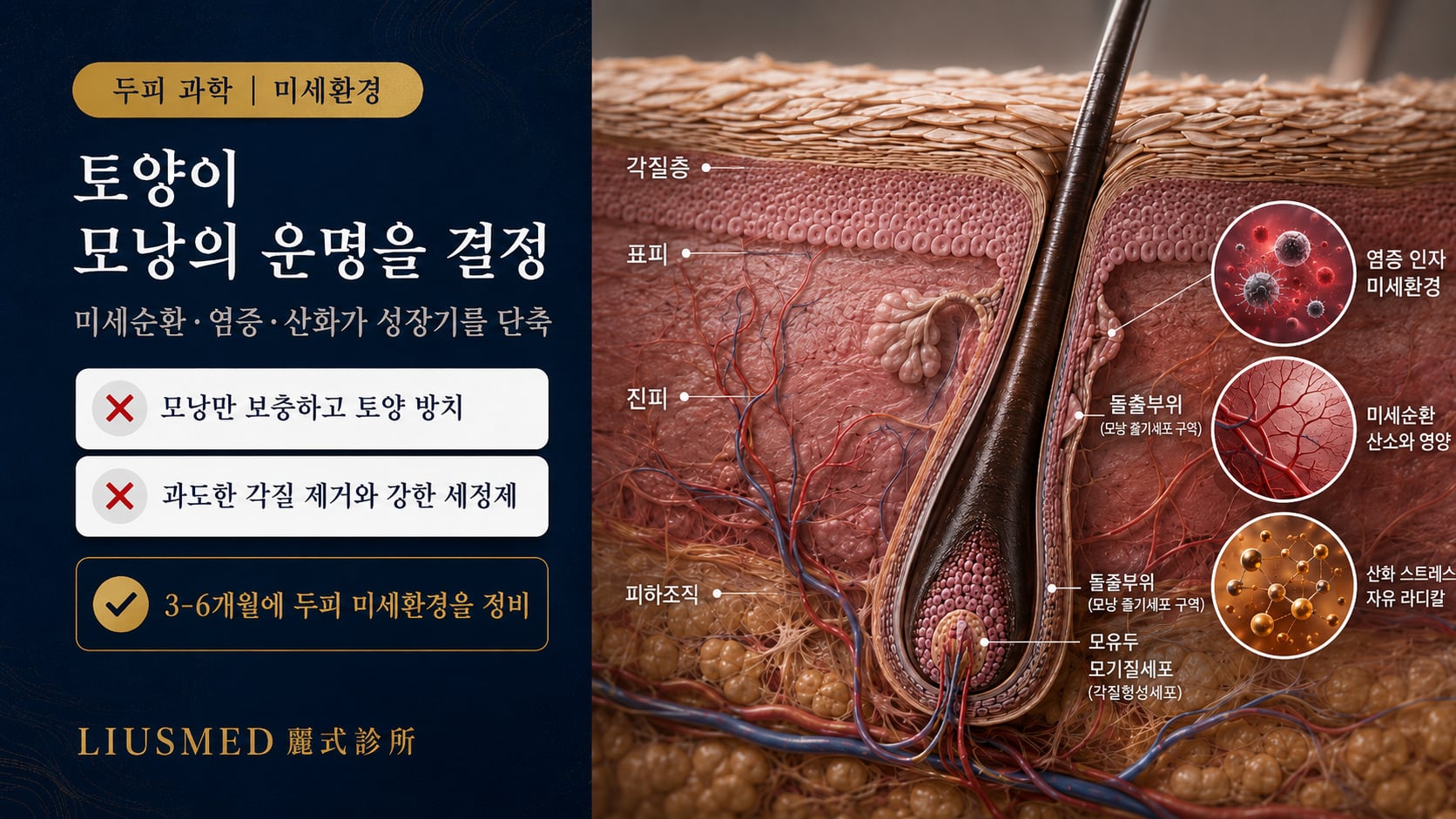 두피 미세환경과 모낭 건강: 염증·미세순환·산화 스트레스가 모량을 결정하는 메커니즘(2026 근거)