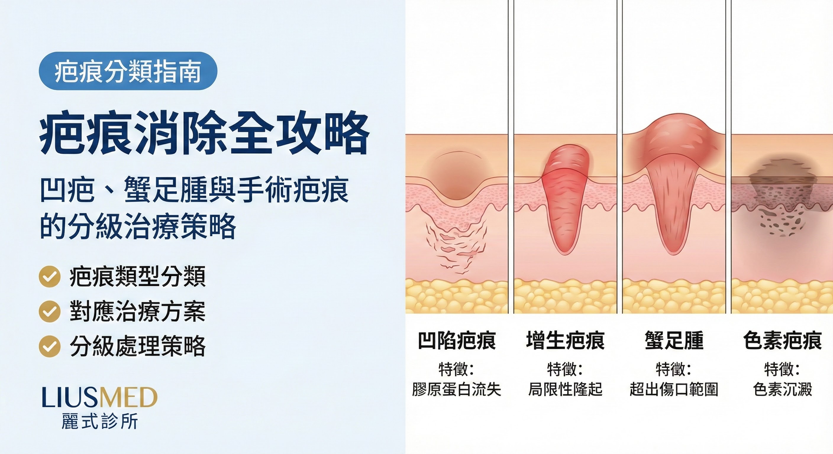 疤痕消除全攻略:凹疤、蟹足腫與手術疤痕的分級治療策略