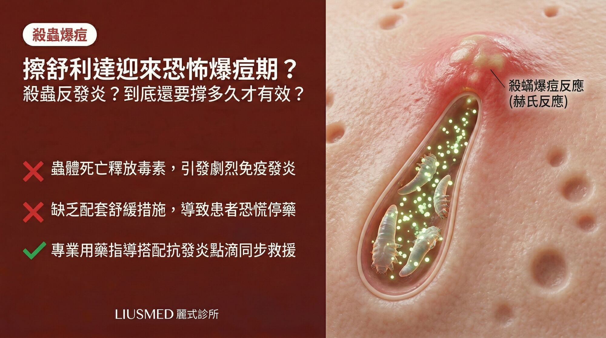 擦舒利達 (Soolantra) 殺蟲卻迎來恐怖「爆痘期」?到底要撐多久?