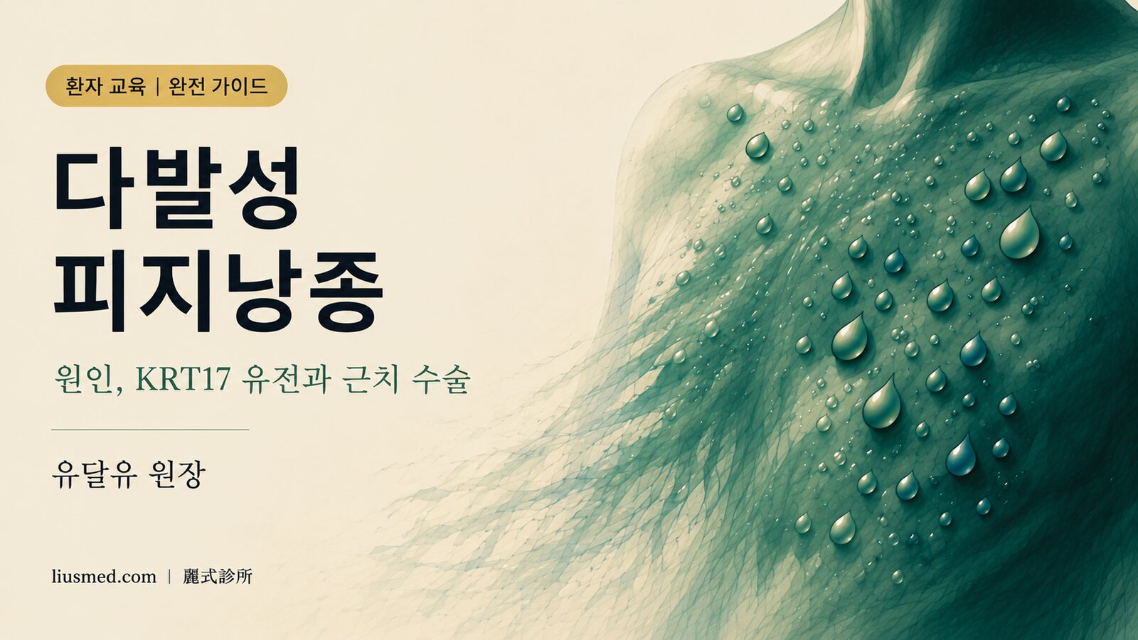 다발성 피지낭종 완전 가이드: 원인, KRT17 유전, 반복 염증과 근치 수술