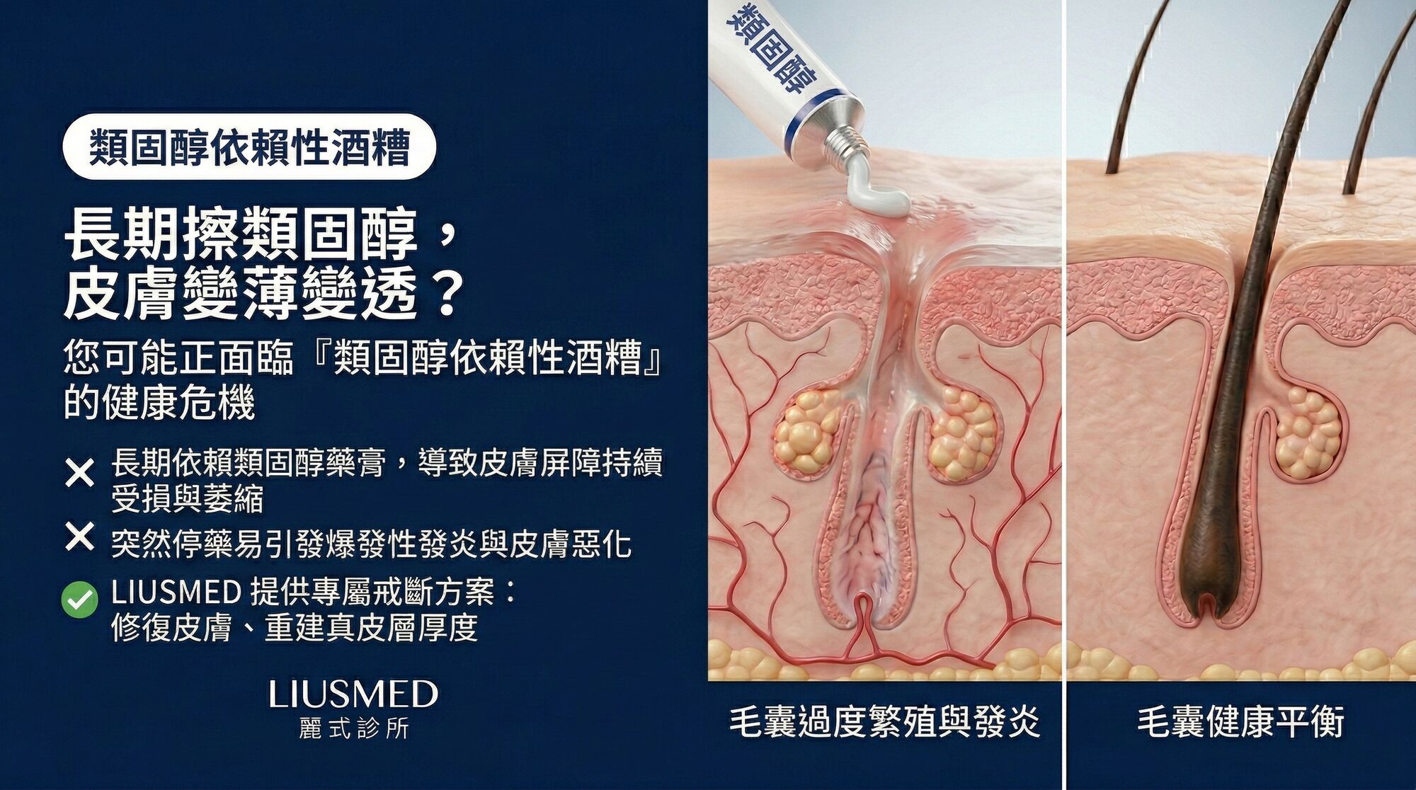 擦類固醇皮膚變薄變透?醫美界不敢說的「類固醇依賴性酒糟」危機