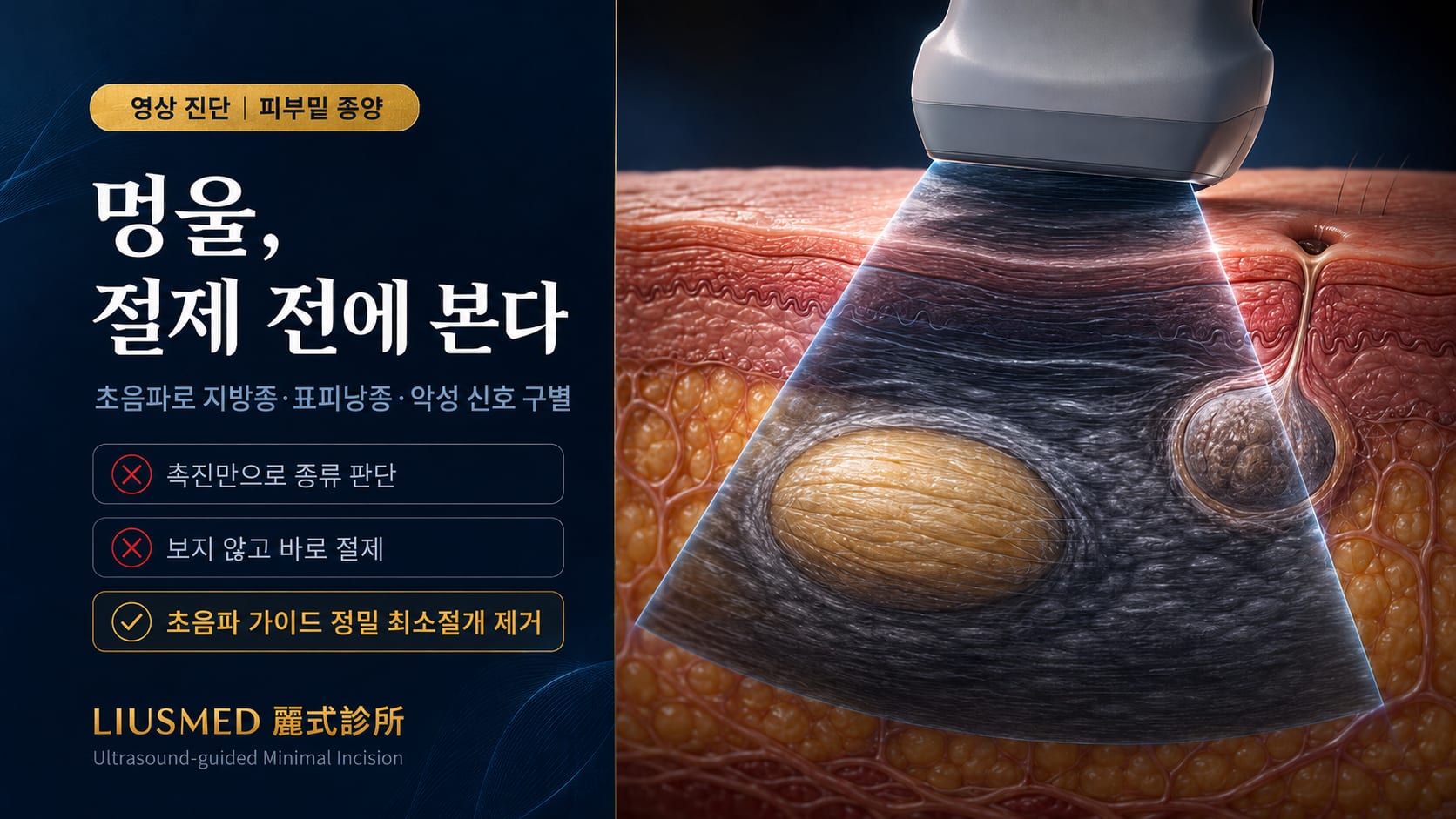 피부밑 멍울을 발견했다면, 바로 절제하기 전에——초음파 검사로 지방종·표피낭종·악성 신호 구별하기