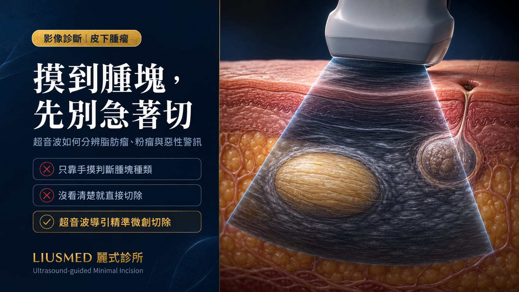 摸到皮下腫塊先別急著切——超音波檢查如何分辨脂肪瘤、粉瘤與惡性警訊