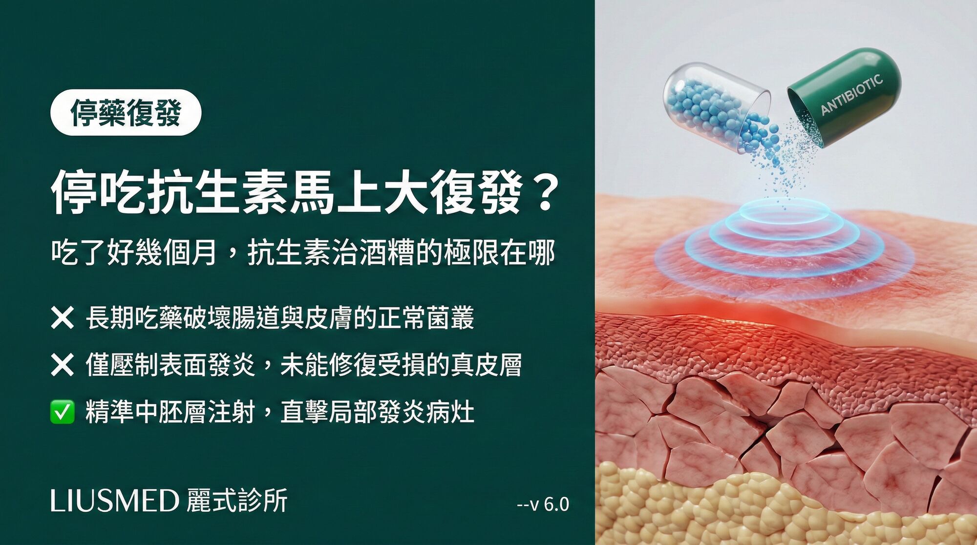 吃了好幾個月四環黴素,停藥馬上大復發?抗生素治酒糟的極限在哪