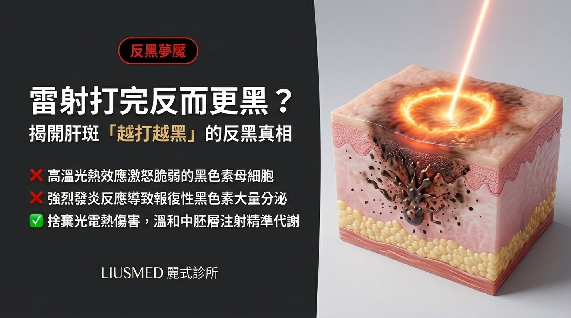 淨膚雷射打完一個月反而更黑?解析肝斑「越打越黑」的反黑 (PIH) 夢魘
