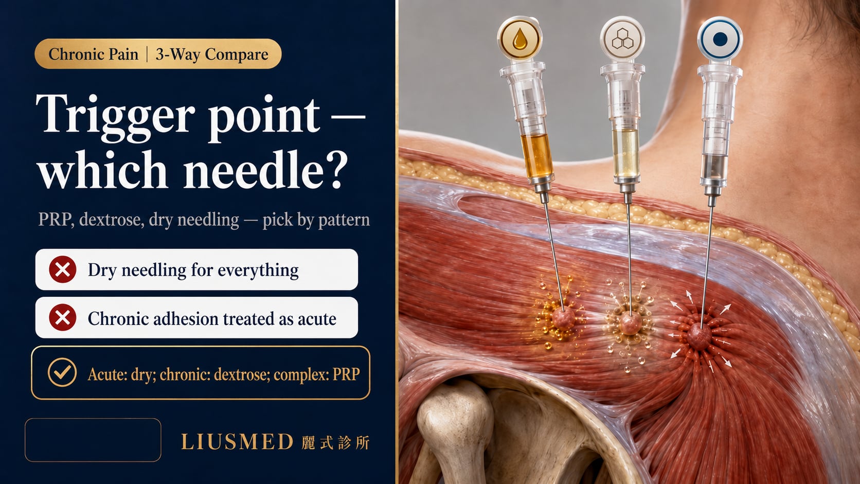 Myofascial Trigger Point Treatment: PRP, Dextrose Prolotherapy, and Dry Needling — A Complete Comparison (2026 Evidence)