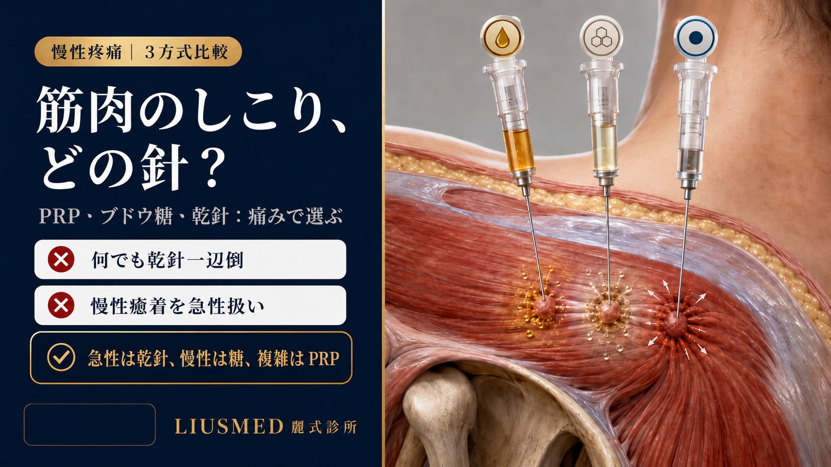 筋膜性疼痛トリガーポイント治療：PRP・ブドウ糖増生・乾針 3 大方式完全比較（2026 エビデンス）