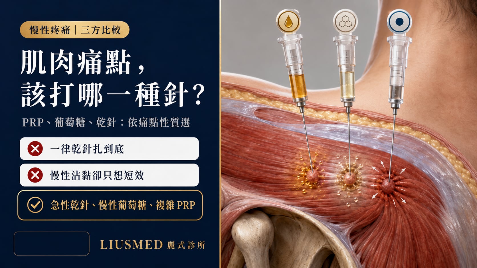肌筋膜激痛點治療：PRP、葡萄糖增生、乾針三大方案完整比較（2026 實證）
