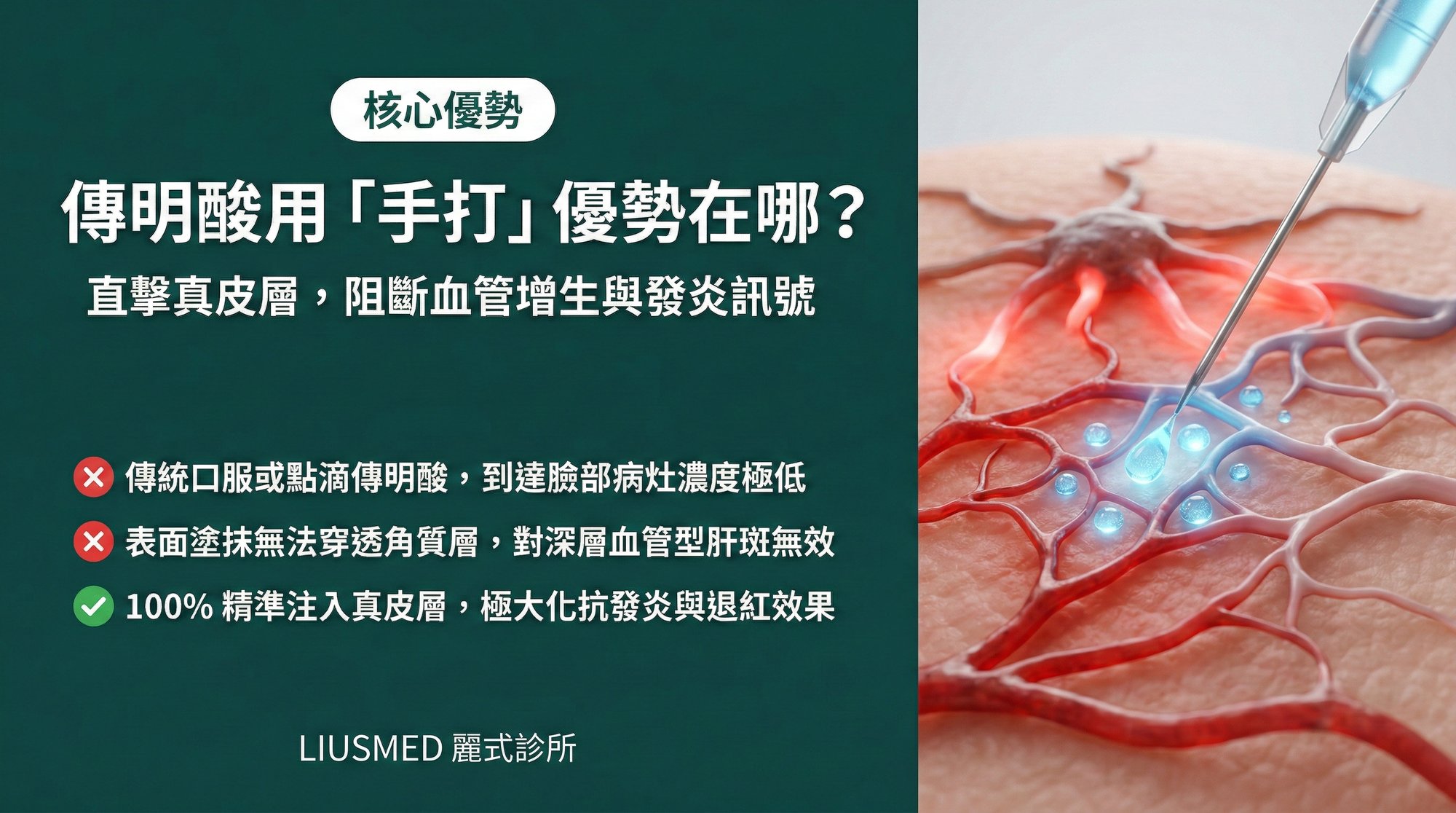 傳明酸用「手打」注射的優勢在哪?直擊真皮層阻斷血管增生與發炎訊號