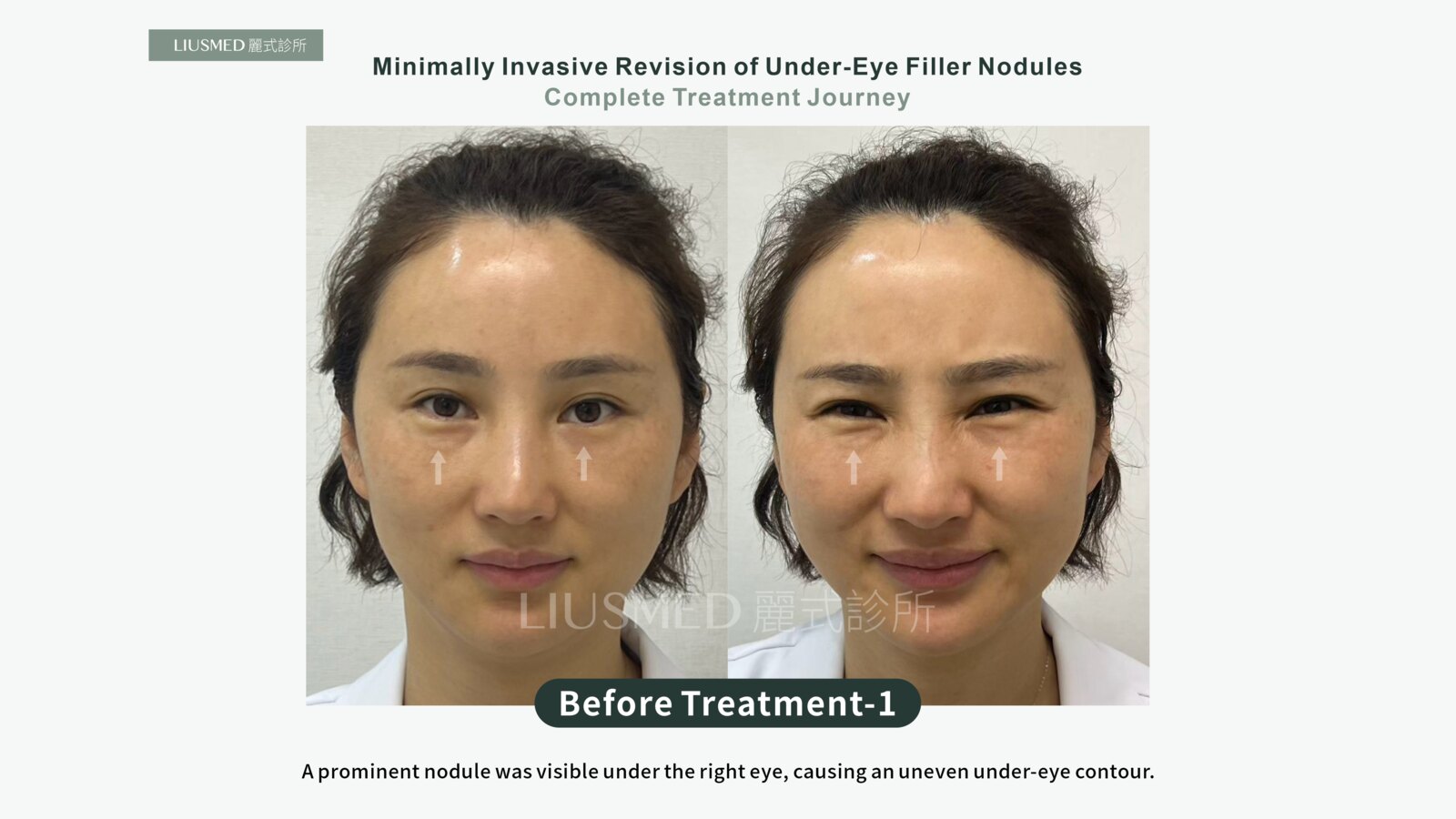 Fat Grafted Under the Eye Turned Into a Lump, Then a Stimulator Was Added to Hide It: A Full Record of Removing Five-Year Stacked Nodules