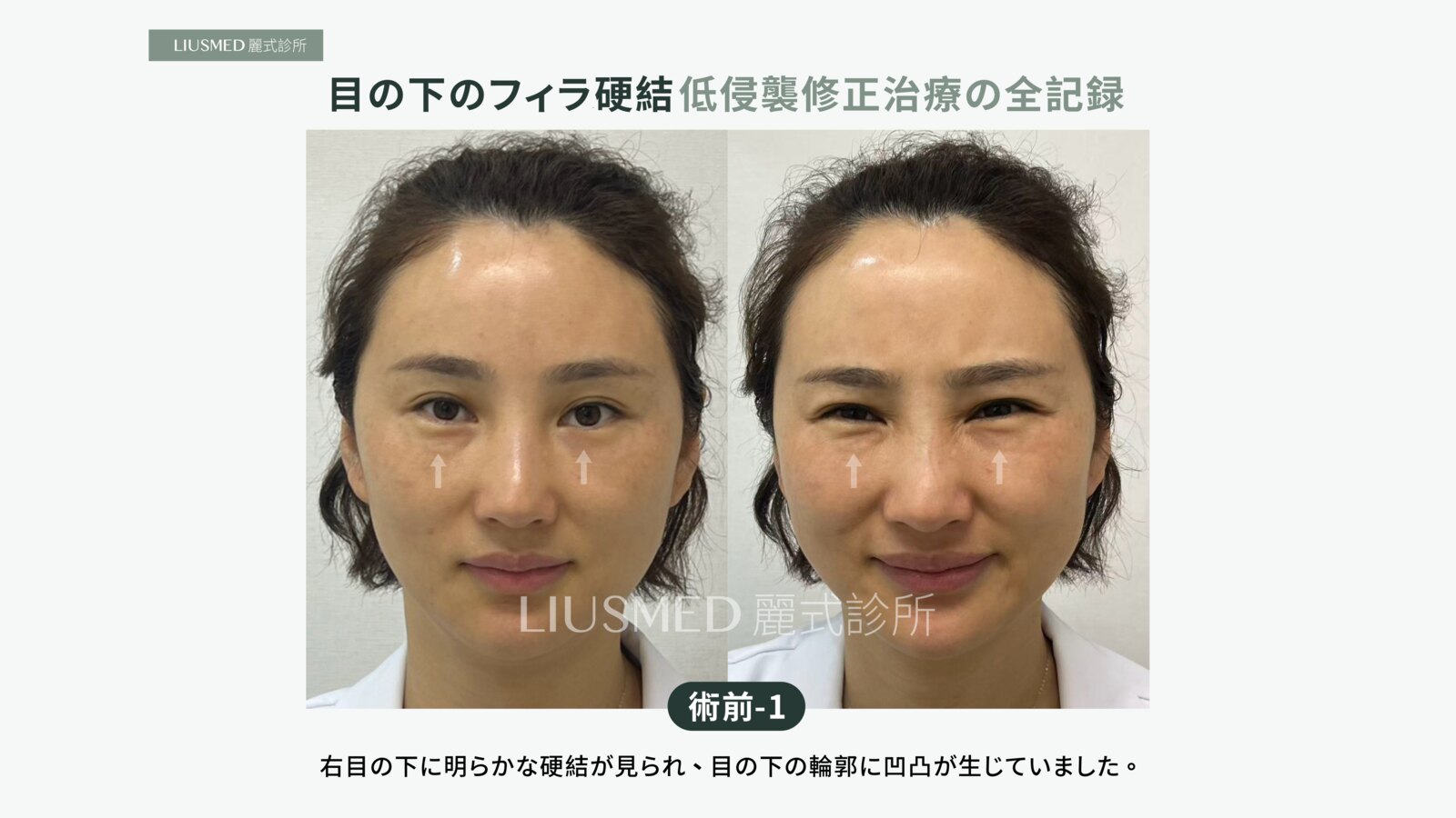 目の下の脂肪注入がしこりに、隠すために刺激材を足してもう一つ:5年重なった硬結を摘出するまでの全記録