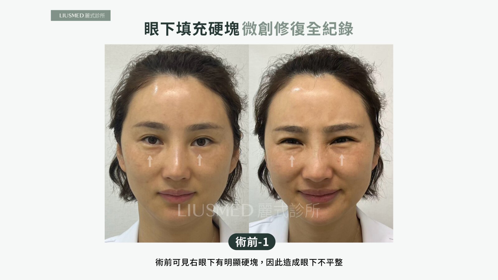 眼下打脂肪變硬塊,補增生劑想蓋掉又多一塊:五年雙層結塊的微創取出全紀錄