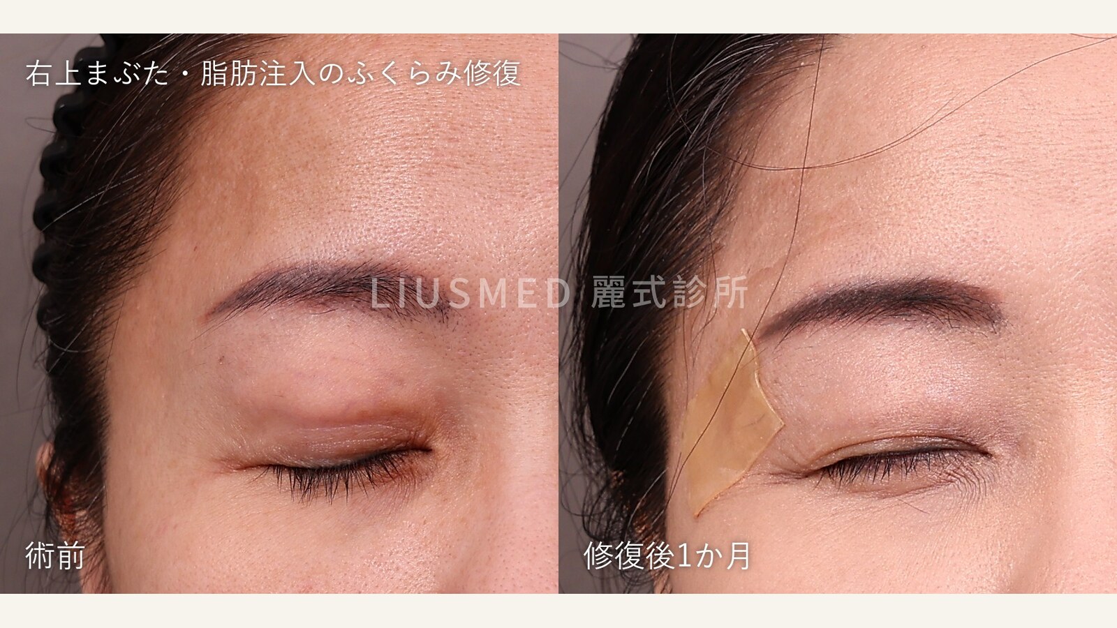 上まぶたの脂肪注入後、どんどん出っ張ってきた:まず右目だけ摘出、同じ1枚の写真の中にある比較の記録