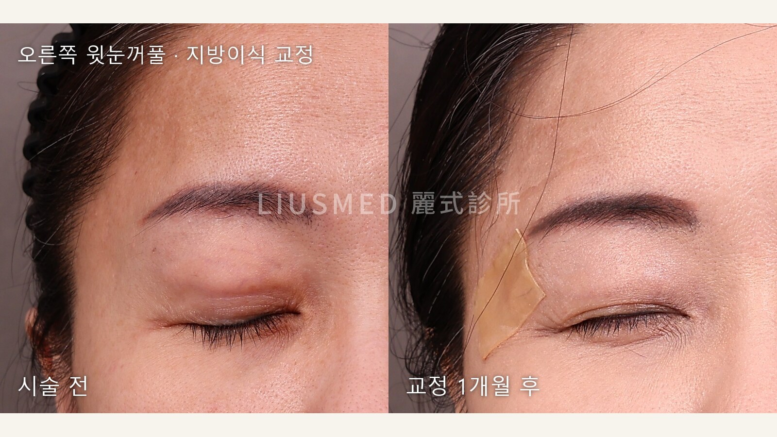 윗눈꺼풀 지방이식 후 점점 튀어나온 눈꺼풀: 오른쪽 눈만 먼저 제거, 같은 사진 한 장 안의 비교 기록