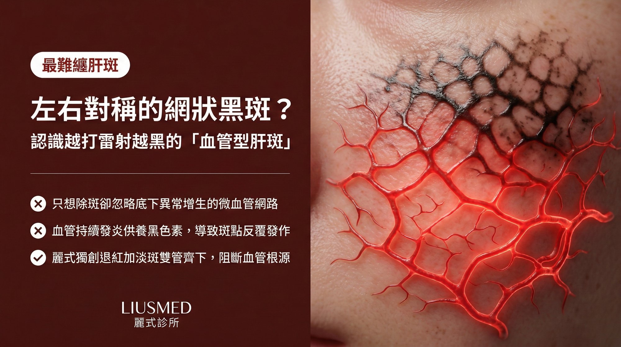 臉上出現左右對稱的網狀黑斑?認識最難纏的「血管型肝斑」
