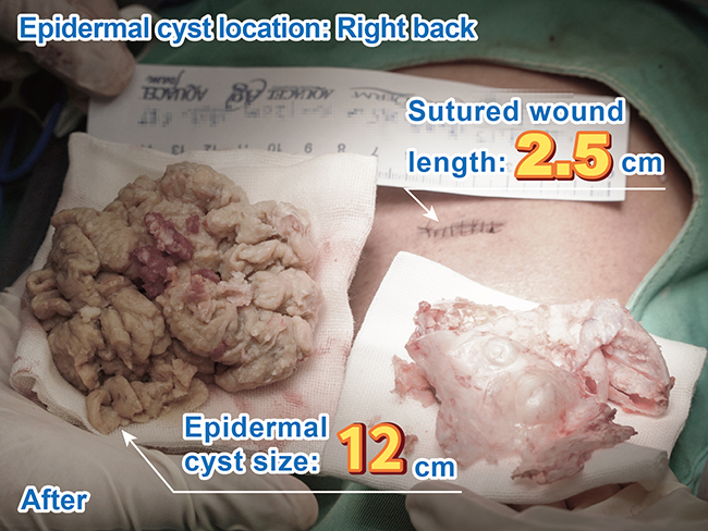 術後 - 右上背部