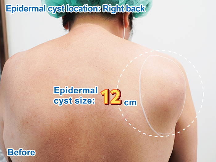 표피낭종 - 오른쪽 상부 등 시술 전