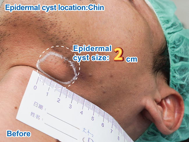 표피낭종 - 왼쪽 하악 시술 전