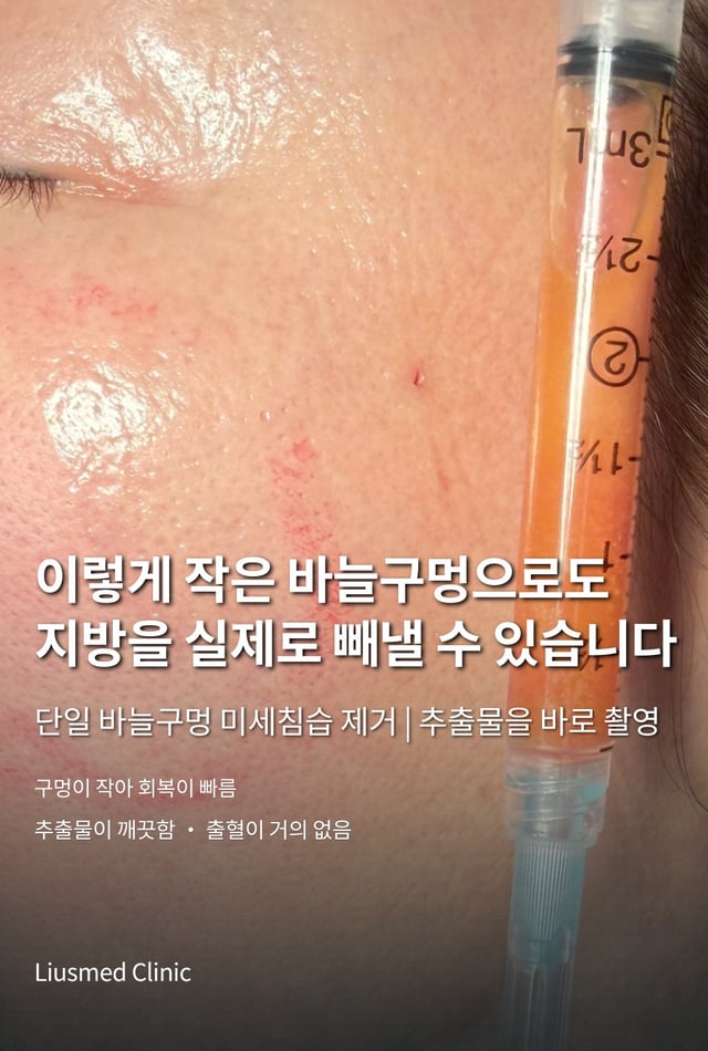 단일 바늘구멍 제거의 실제 사진: 볼의 바늘구멍과 방금 꺼낸 지방