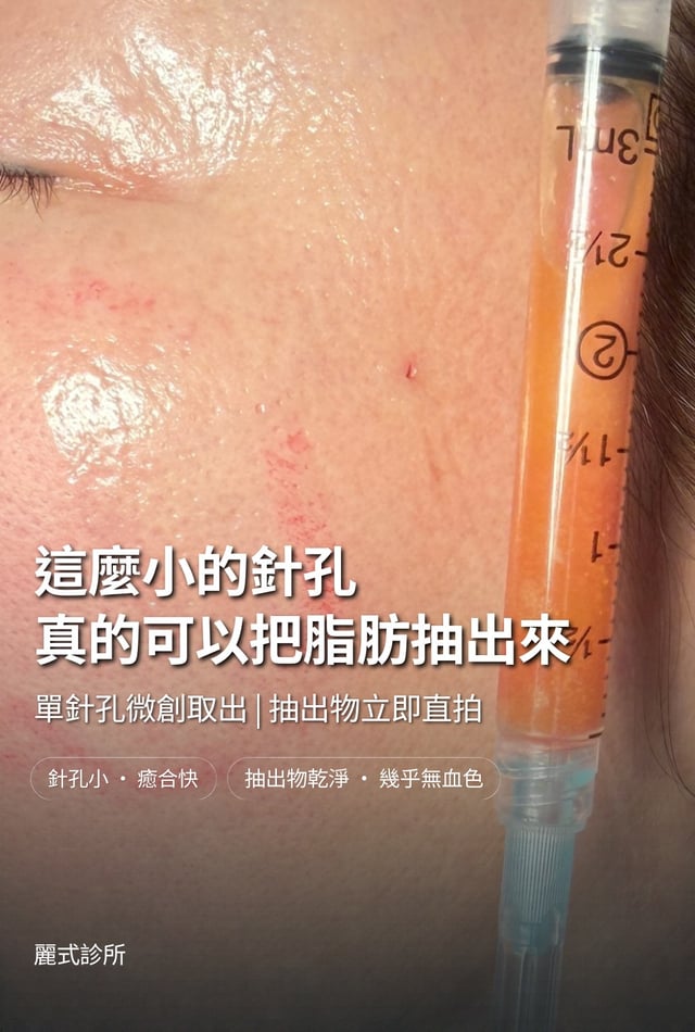 單針孔微創取出的實際照片:臉頰上的針孔與剛取出的脂肪