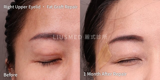 Right upper eyelid bulging after a fat graft: before and one month after staged pinhole extraction