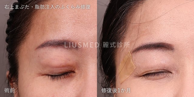 脂肪注入後にふくらんだ右上まぶた:術前と段階的針孔摘出から1か月後