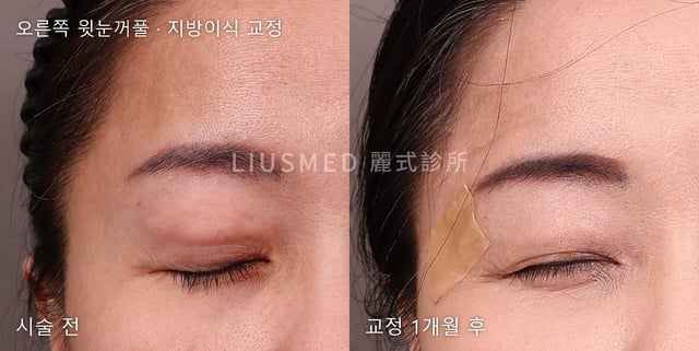 지방이식 후 돌출된 오른쪽 윗눈꺼풀: 시술 전과 단계적 바늘구멍 제거 1개월 후
