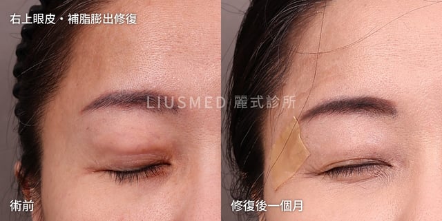 右上眼皮補脂後膨出:術前與漸進式針孔取出後一個月