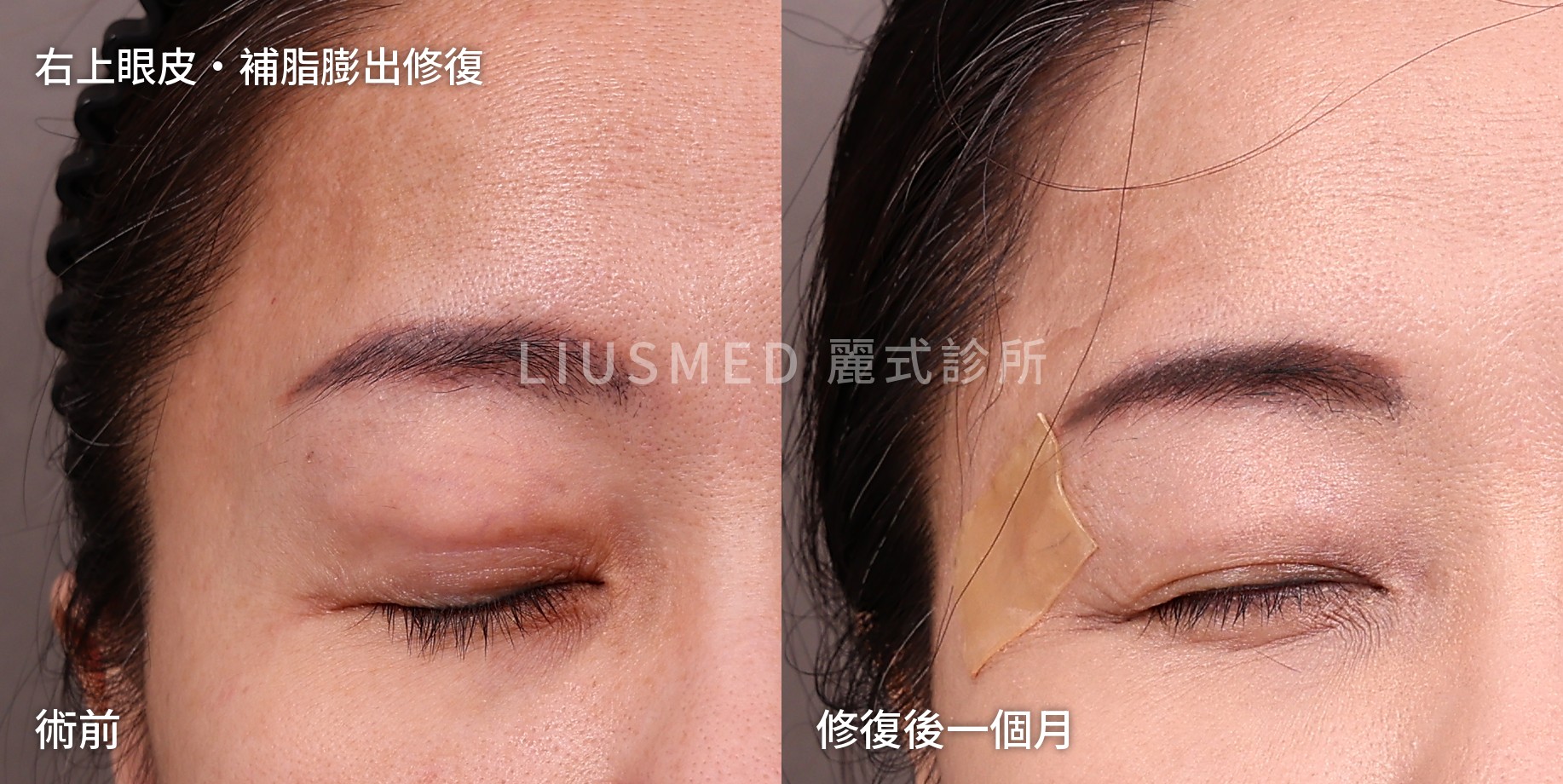 只先做右眼：同一張照片裡的對照組