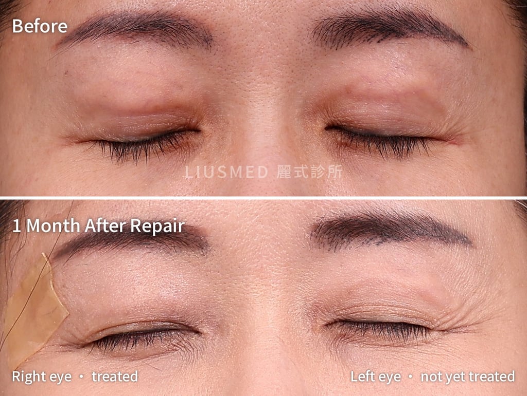 Staged extraction for upper eyelid fat graft bulging: top row, before, both upper eyelids bulge; bottom row, one month after, right eye treated and left eye not yet treated