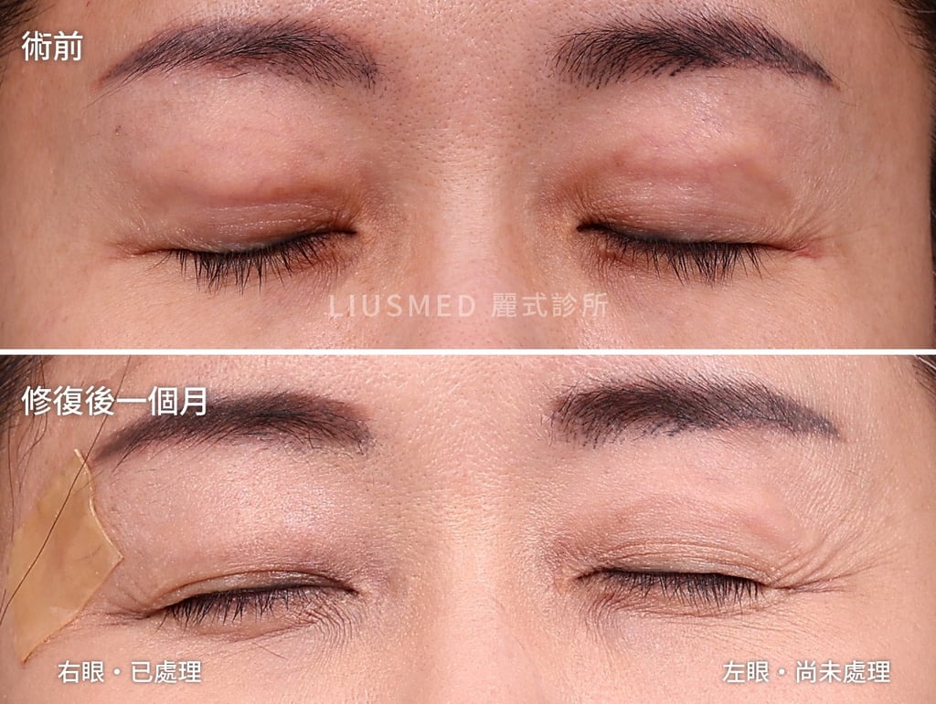 上眼皮補脂膨出的漸進式取出:上排術前兩邊上眼皮都鼓起;下排修復後一個月,右眼處理過、左眼尚未處理