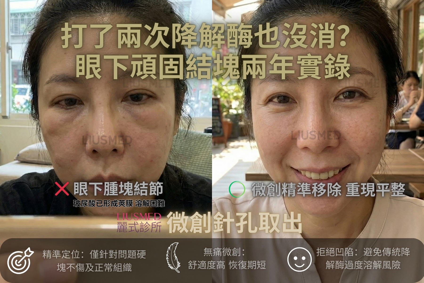 打了兩次降解酶都沒消？眼下這兩坨「假眼袋」，竟是玻尿酸包了莢膜