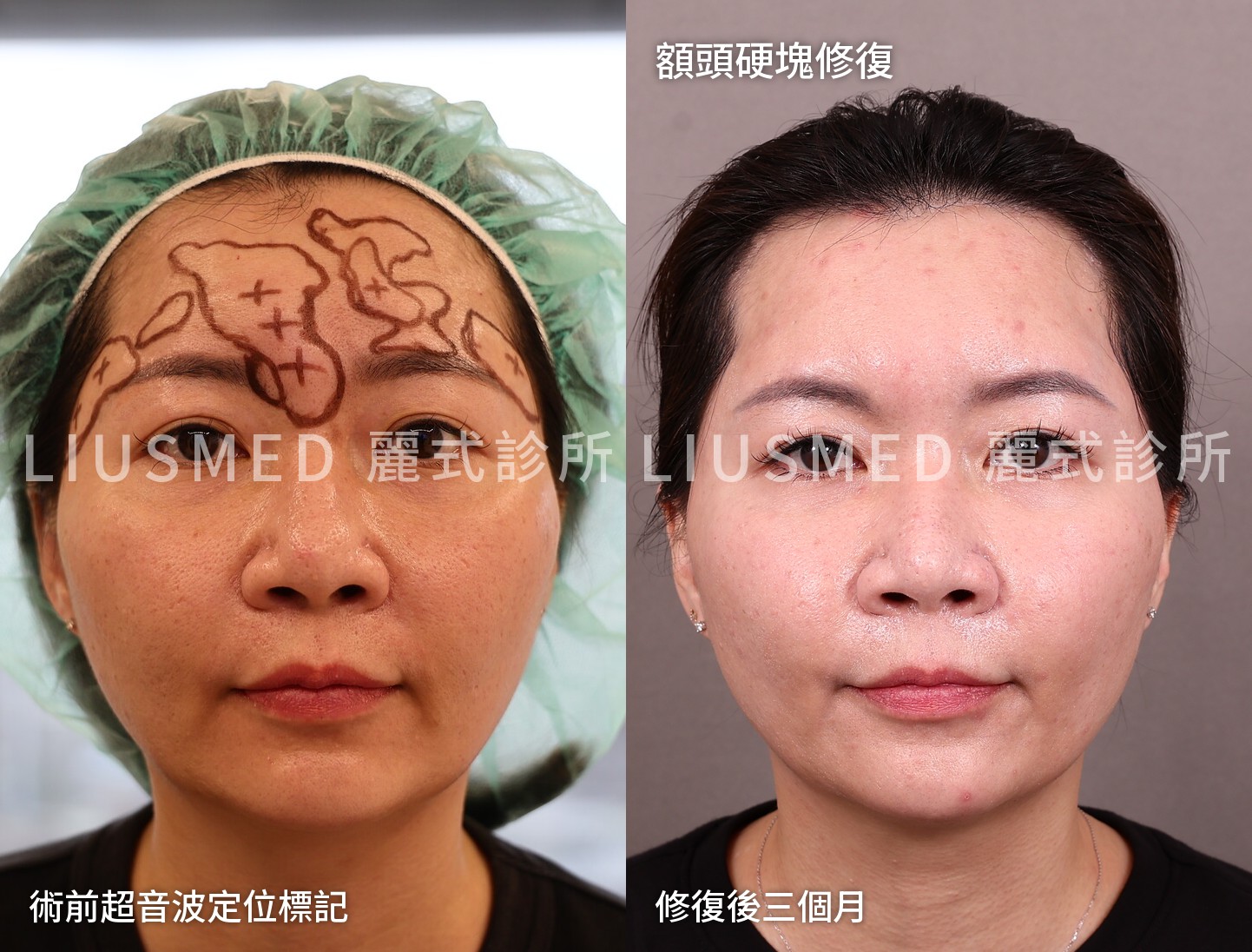 兩年沒消的額頭硬塊,三個月後才拍的那組照片