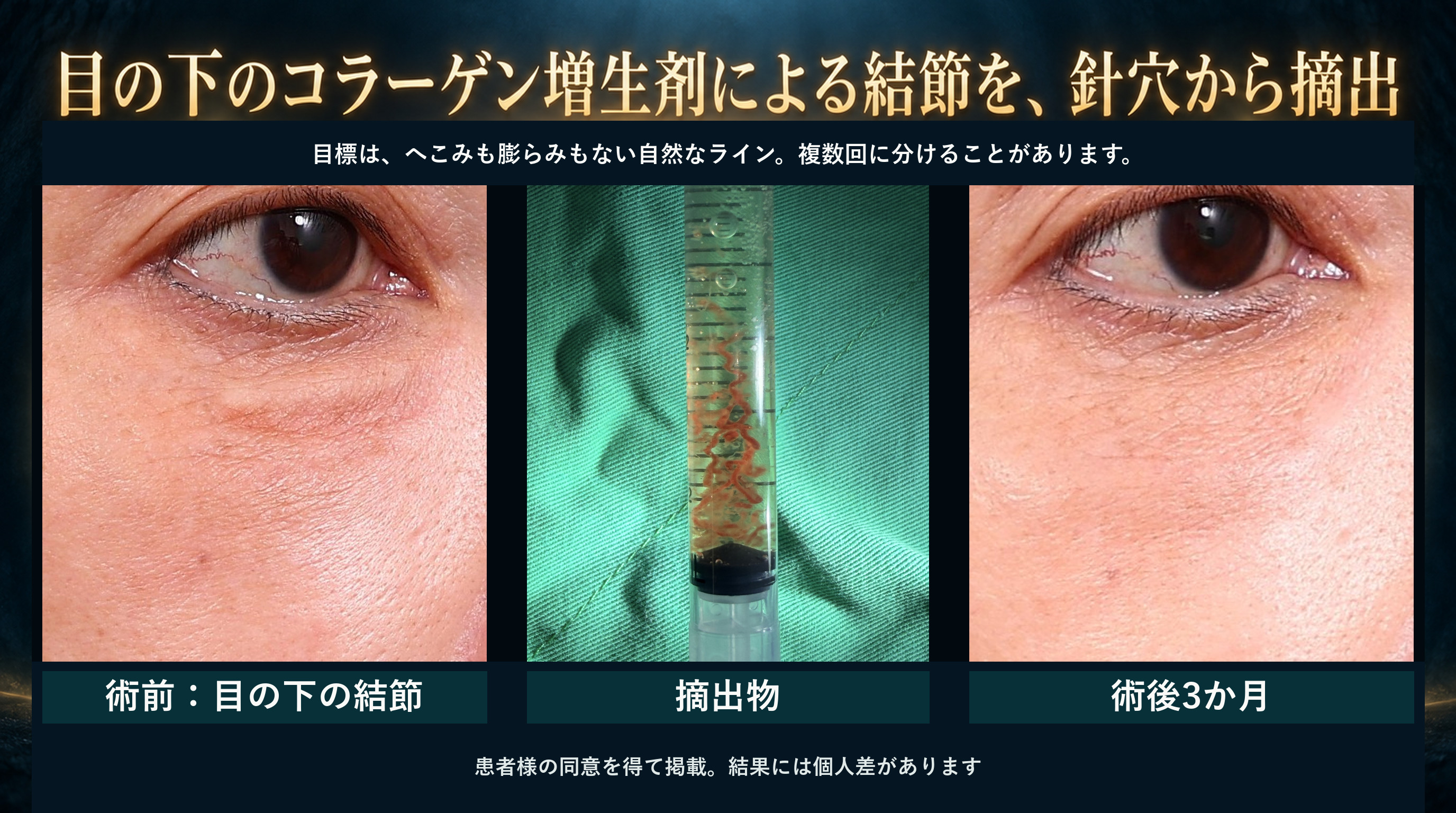 術前・摘出物・術後3か月