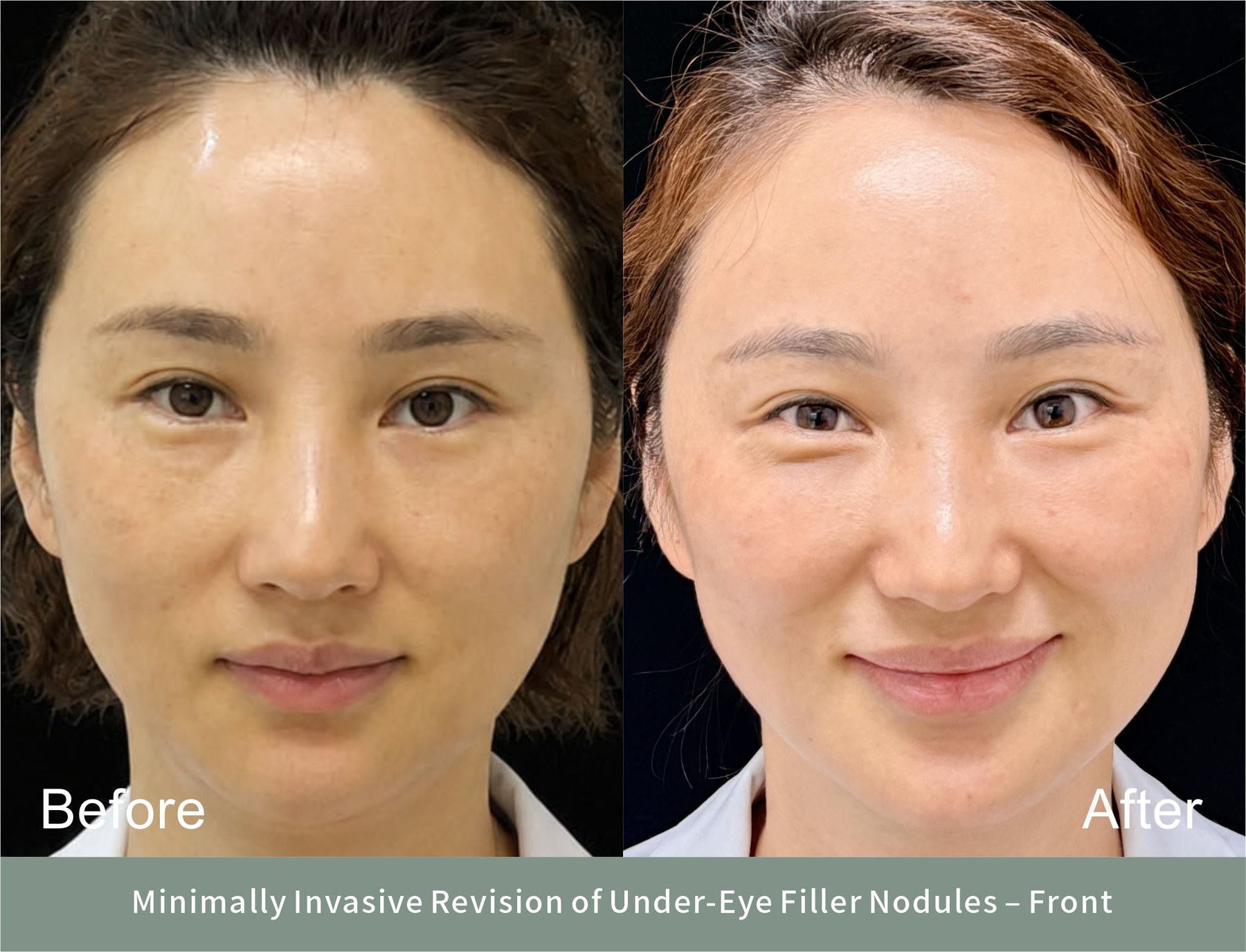 Five years under her eye, and it popped out every time she smiled