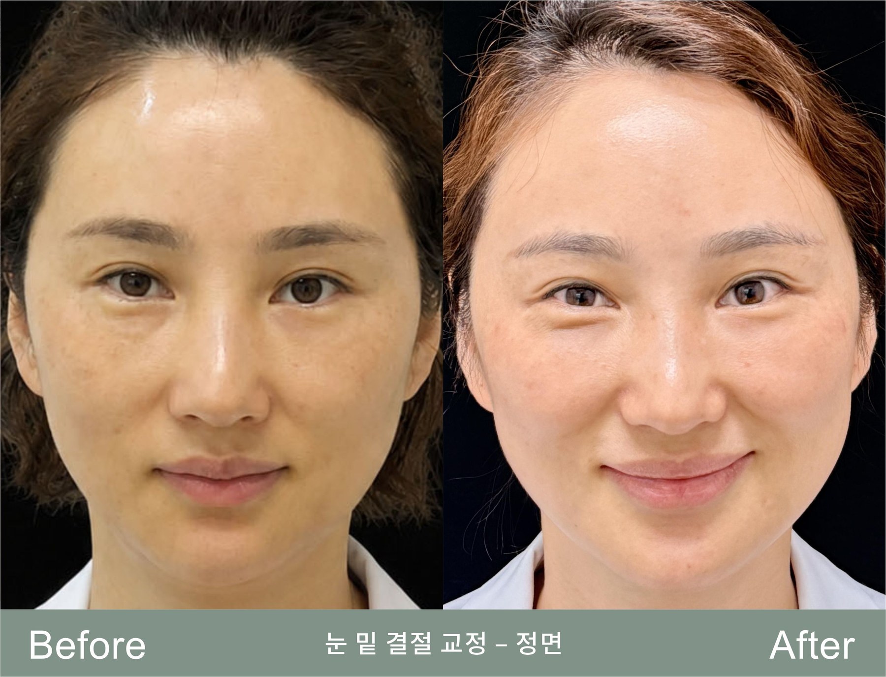 5년 동안 눈 밑에 남아 있던 결절, 웃을 때마다 확연히 드러났습니다