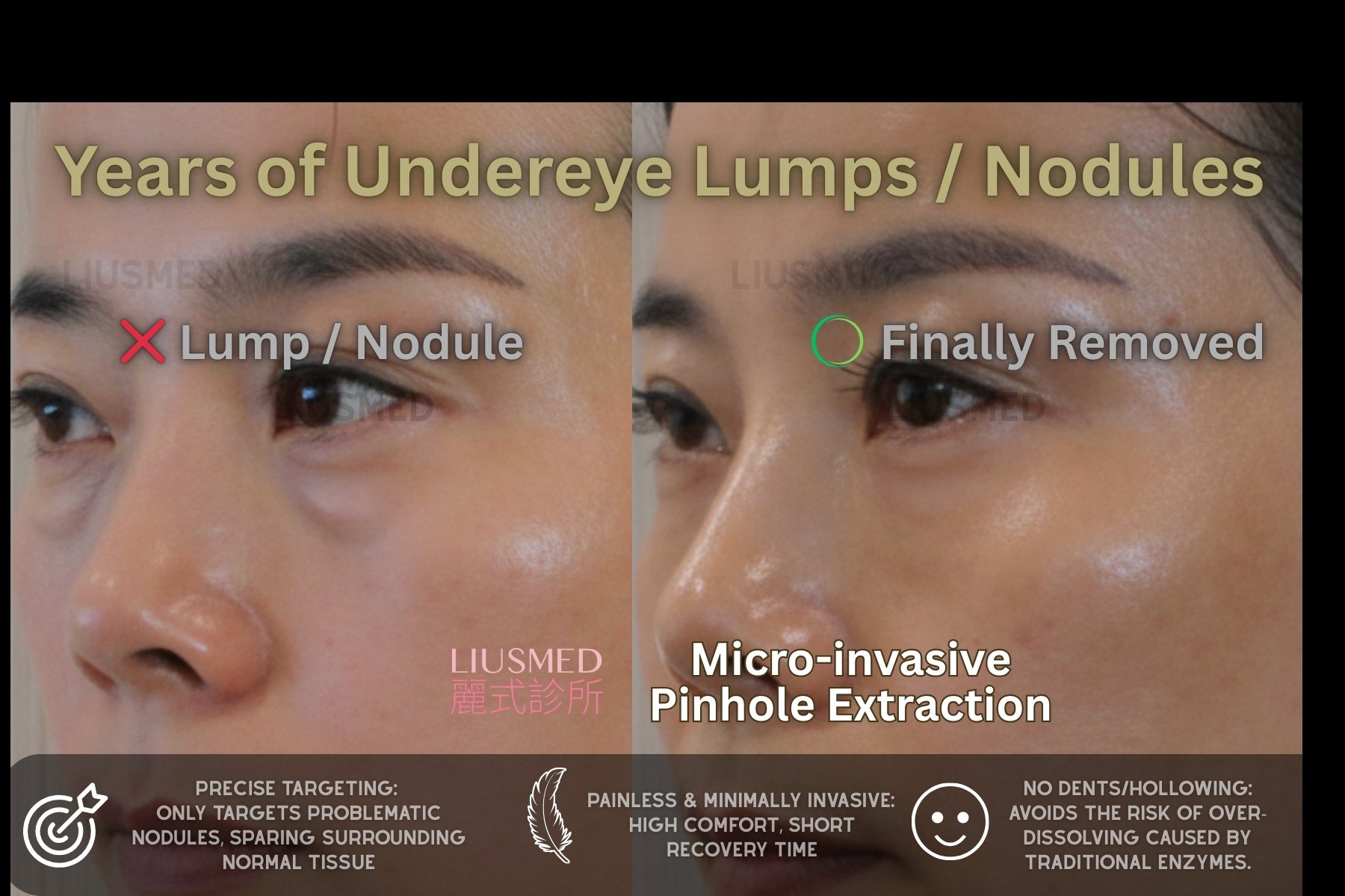 필러 수정 - 눈 아래 시술 전