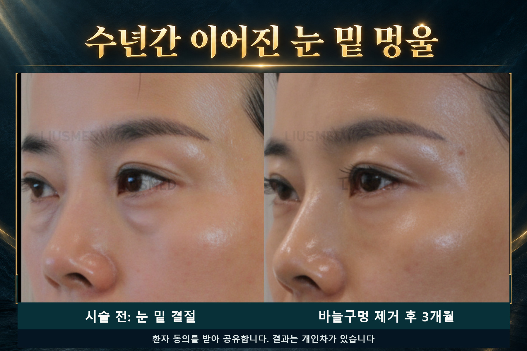 눈 아래 그 "볼록한 것", 3년이나 따라다녔다