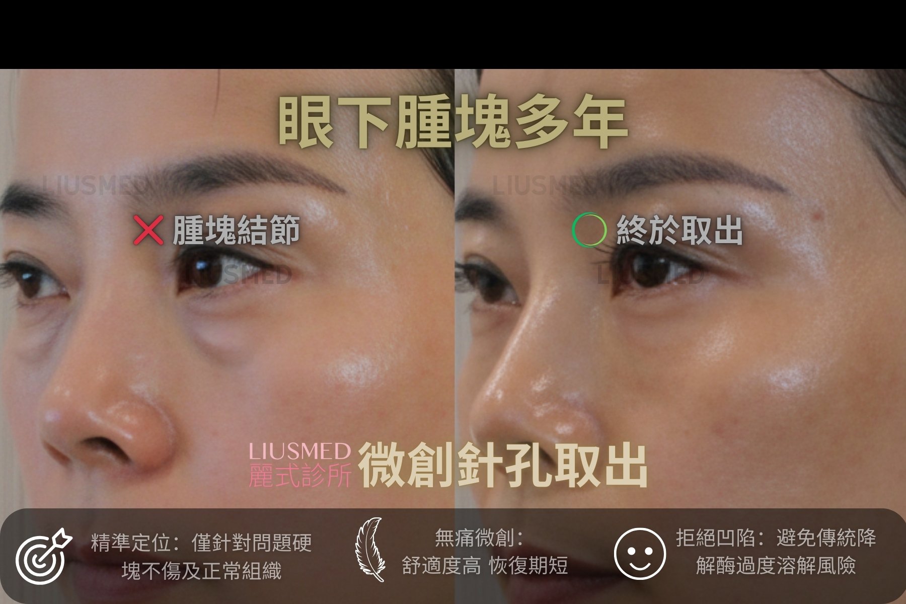 填充物修復 - 眼下部 術前