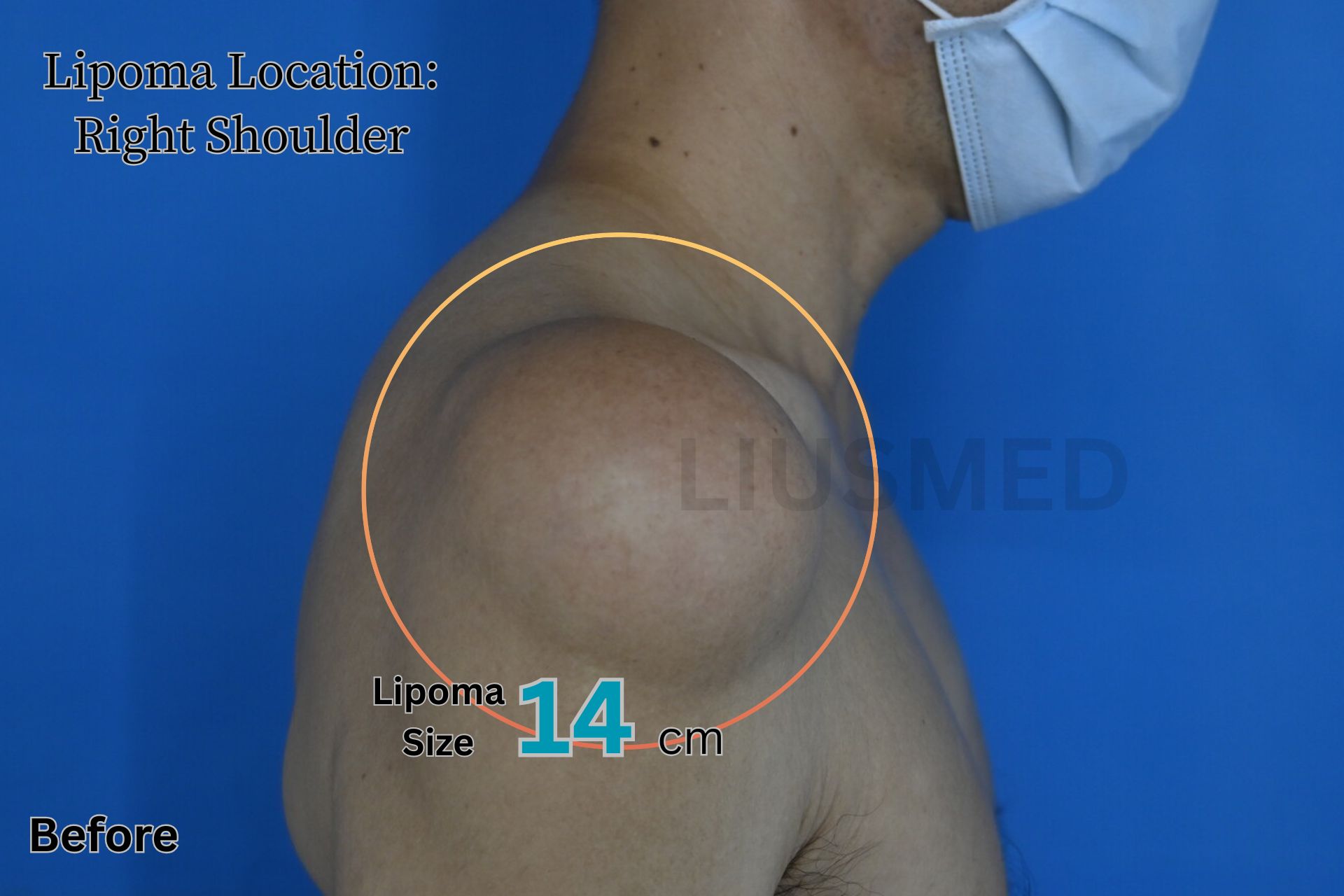 지방종 - 오른쪽 어깨 시술 전