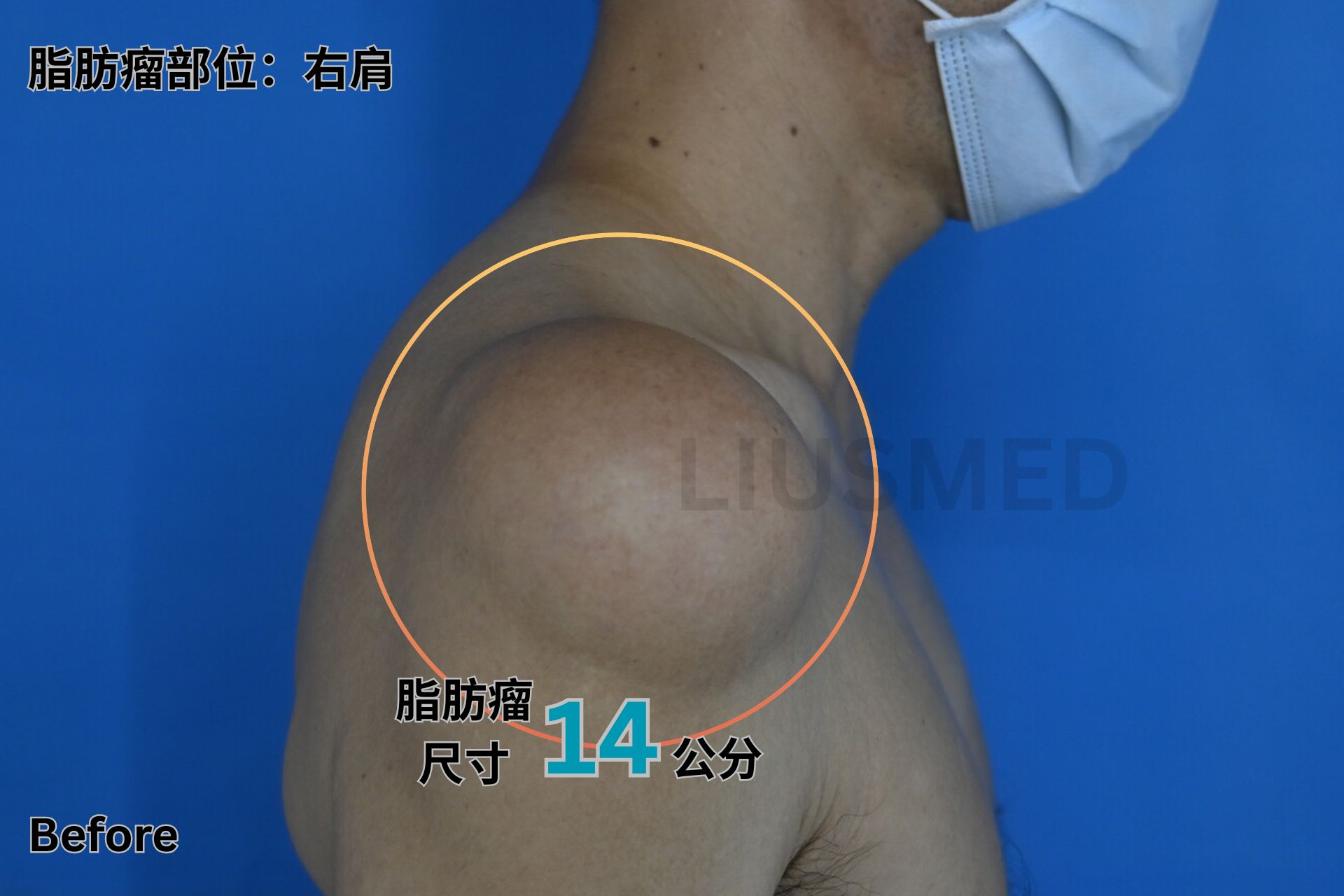 脂肪瘤 - 右肩 術前