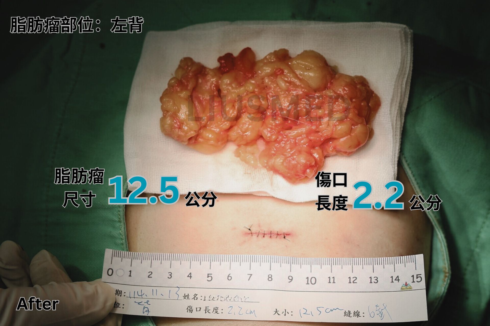 術後 - 左背